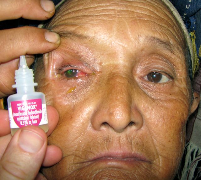 Saved Eye